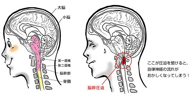 脳幹圧迫による自律神経への影響の図