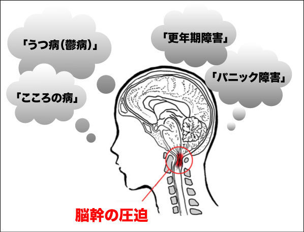 脳幹の圧迫により引き起こされる症状