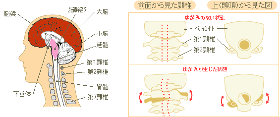 頸椎の歪みのイラスト