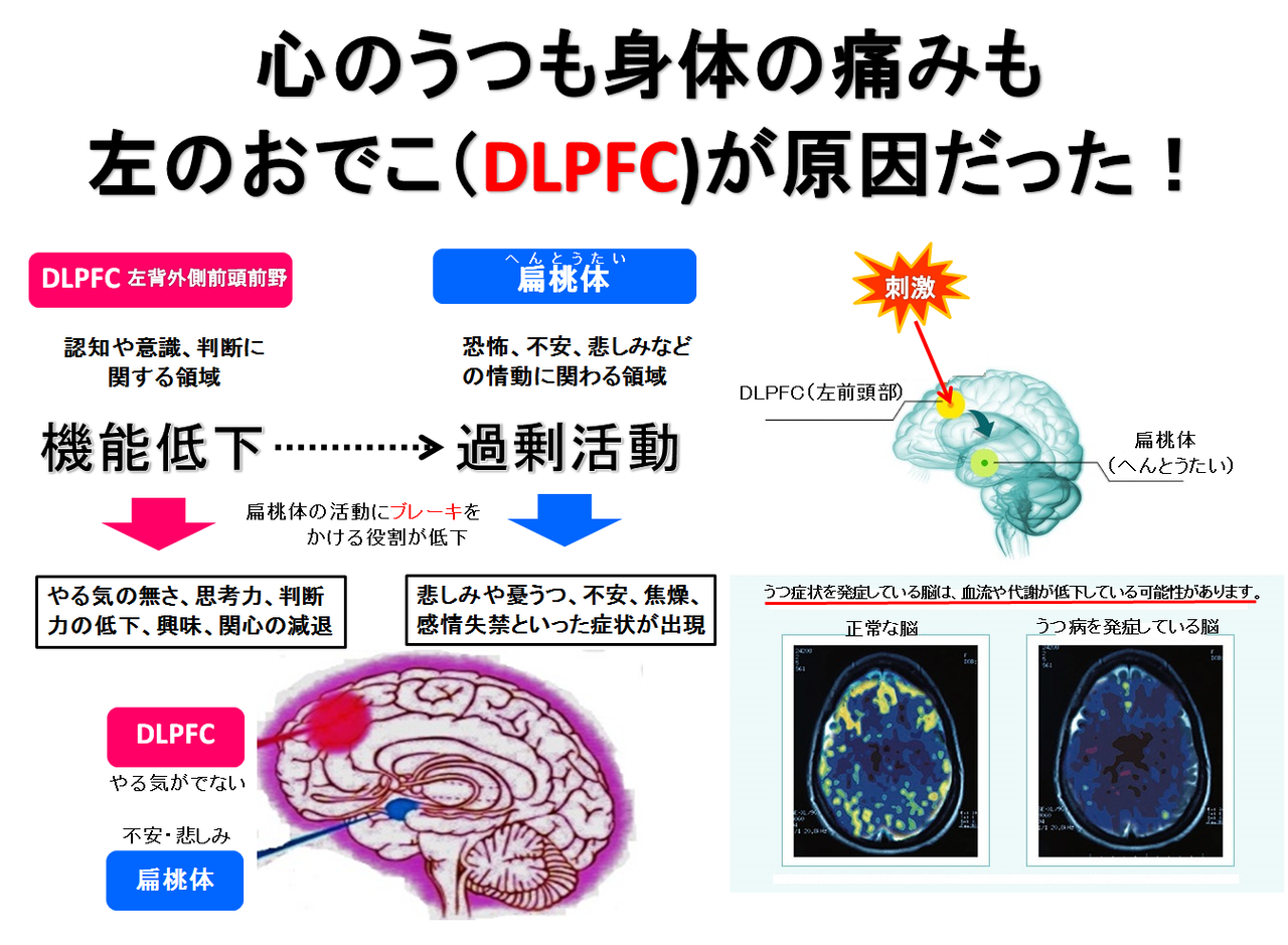 DLPFC（左のおでこ）がうつと身体の痛みが関与